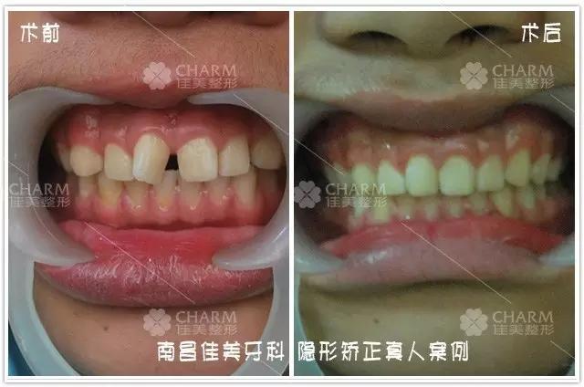 “隱形矯正 試戴牙套”公益活動招募中，名額僅限50名。