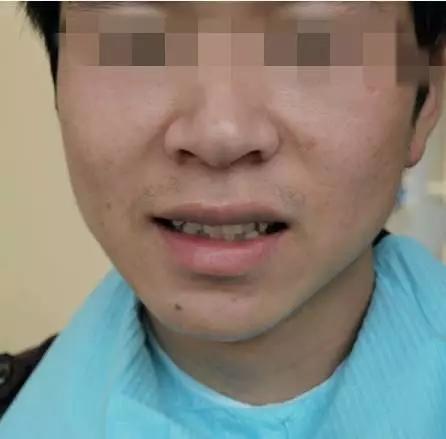 “隱形矯正 試戴牙套”公益活動招募中，名額僅限50名。