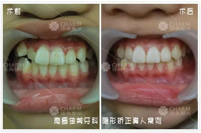 “隱形矯正 試戴牙套”公益活動招募中，名額僅限50名。